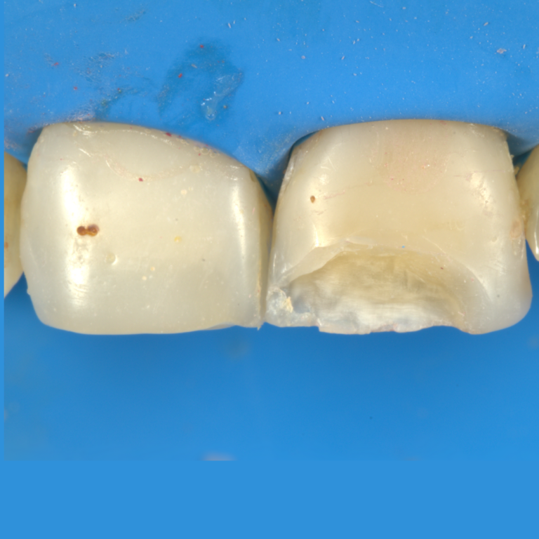 borde incisal fracturado debido a resina en mal estado